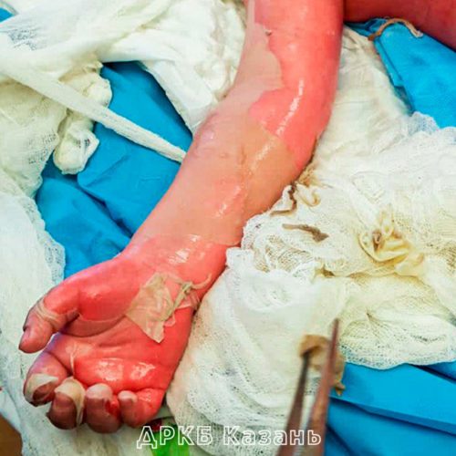 Ребёнок с 73% ожогом провёл в ДРКБ 2 месяца. В течение всего срока медики боролись за жизнь и здоровье маленького пациента